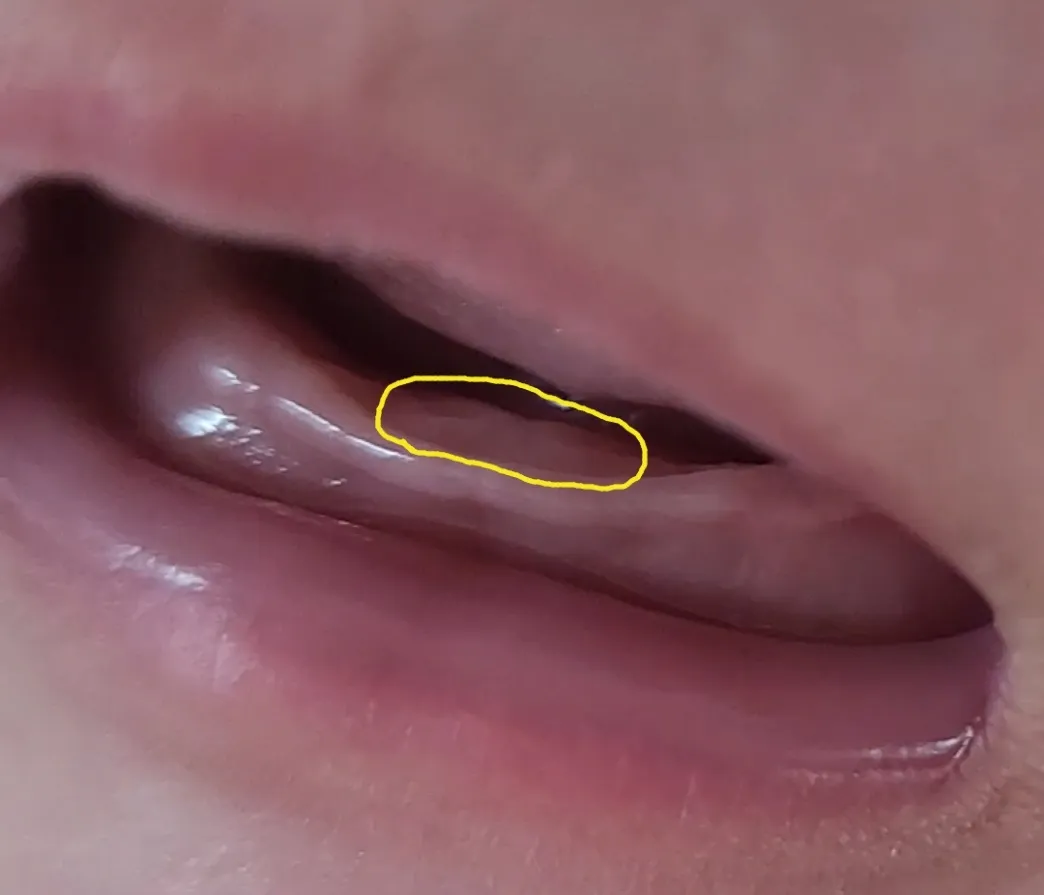 92일 아기 이가 나려는걸까요 ㅠㅠ(사진있어요)