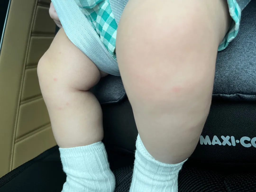 아기 이유식 알레르기 반응일까요..?