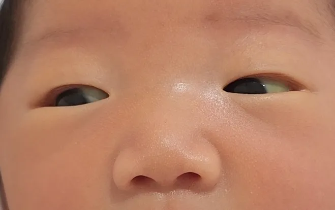 황달수치정상인데 흰자가 노래요