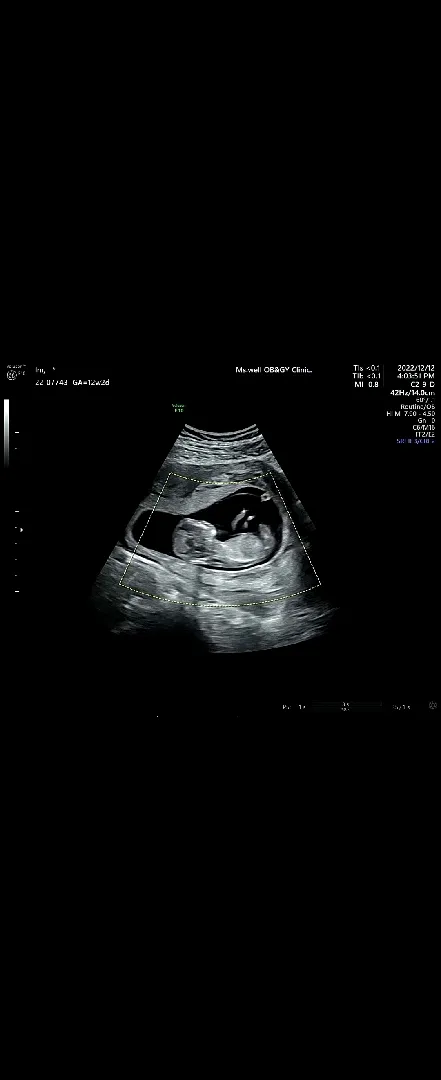 [12주 초음파] 성별 문의드립니당 👶