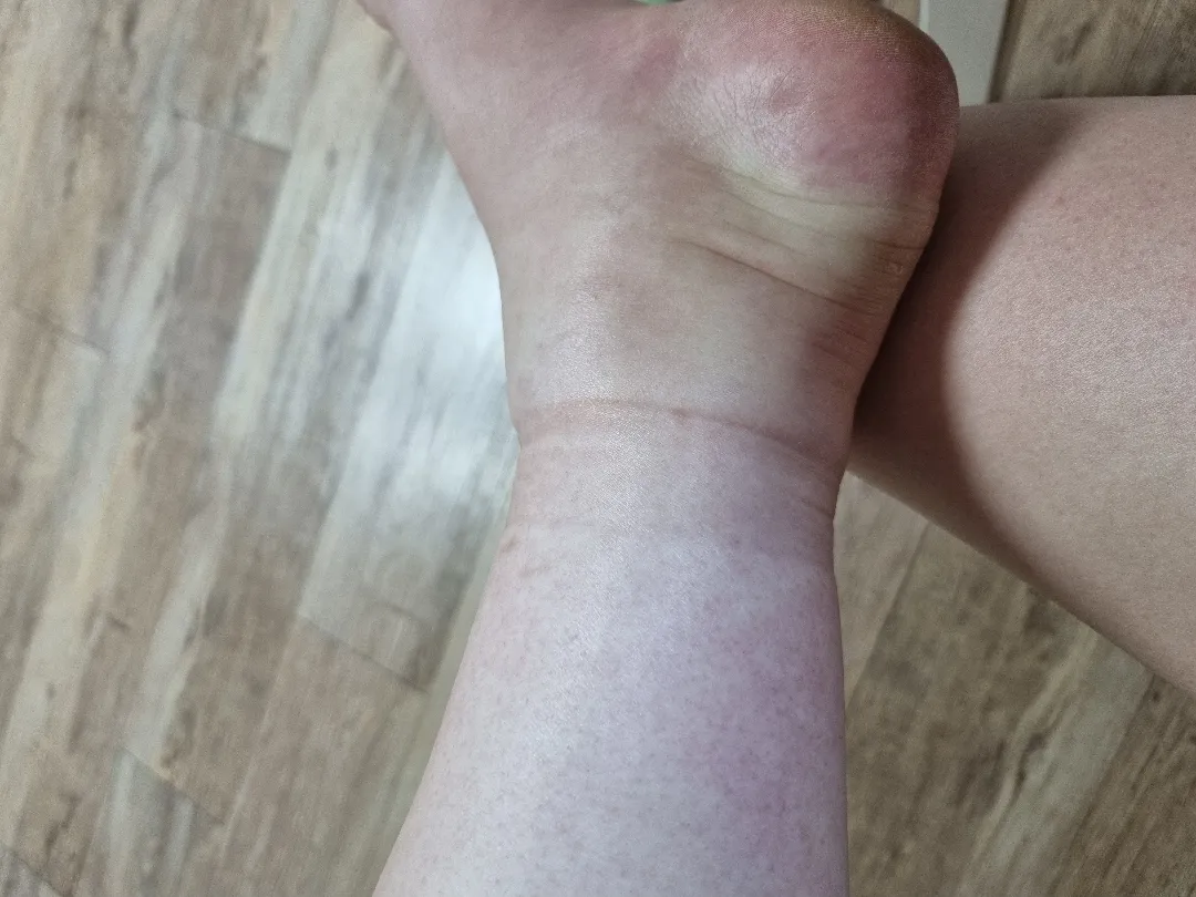 다리부종 괜찮으신가요?