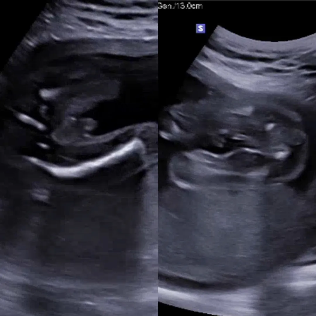 24주 선둥이 성별 좀 ㅠㅠㅠ