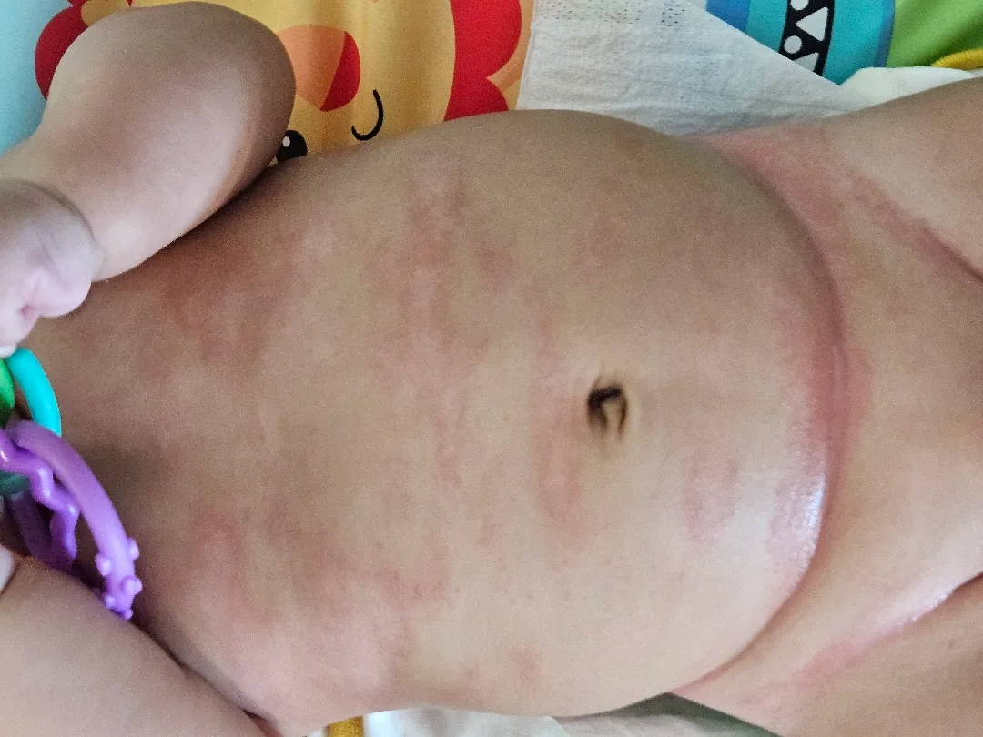 접촉성 피부염, 지루성 피부염
