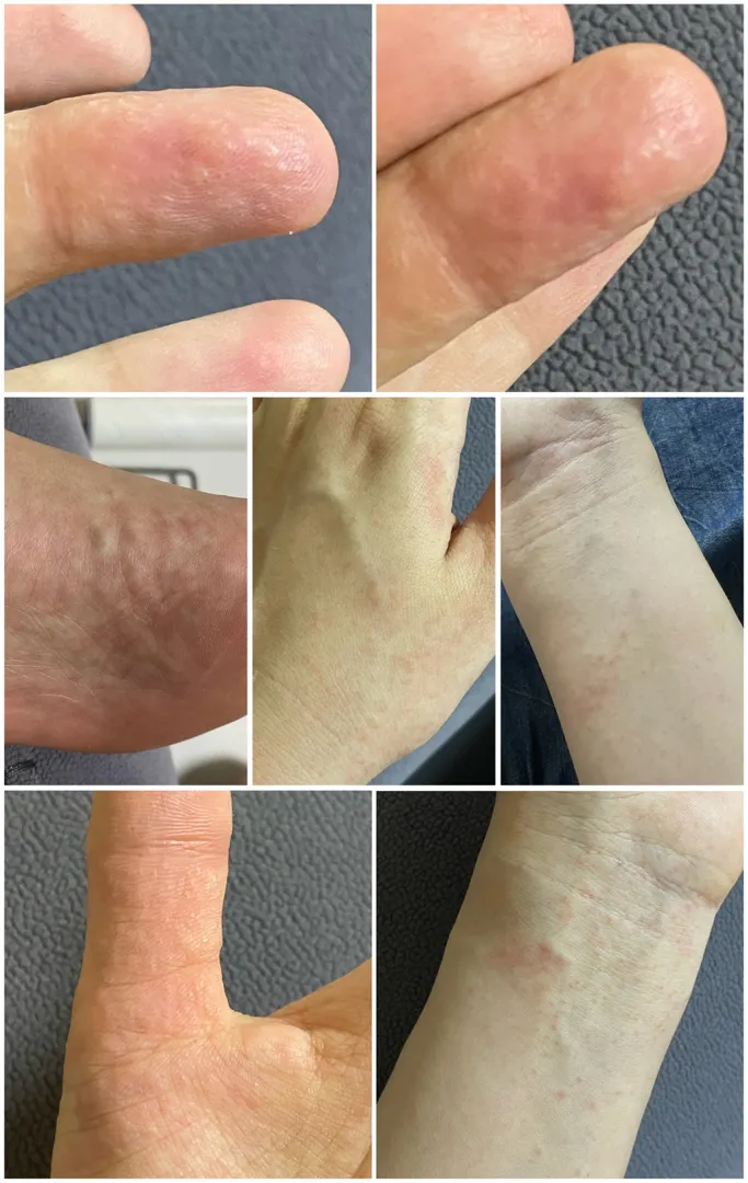 이거 혹시 한포진인가요? ㅜ 소양증인가요? 뭘까요?