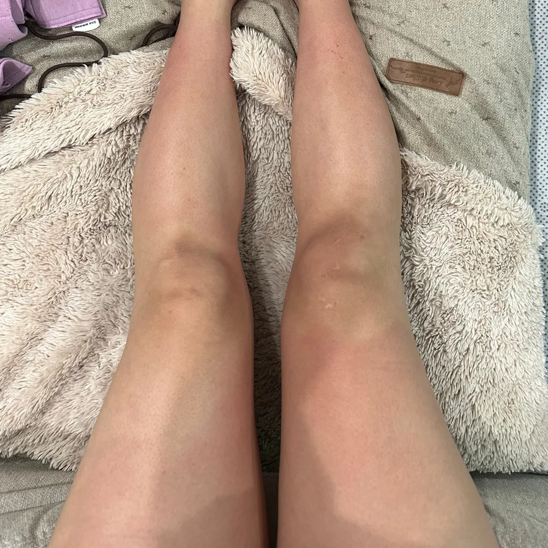 다리가 울긋불긋하신 분 있나요??