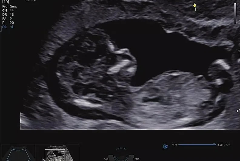 12주4일에찍은초음파사진인데 성별이딱나왔다네요~