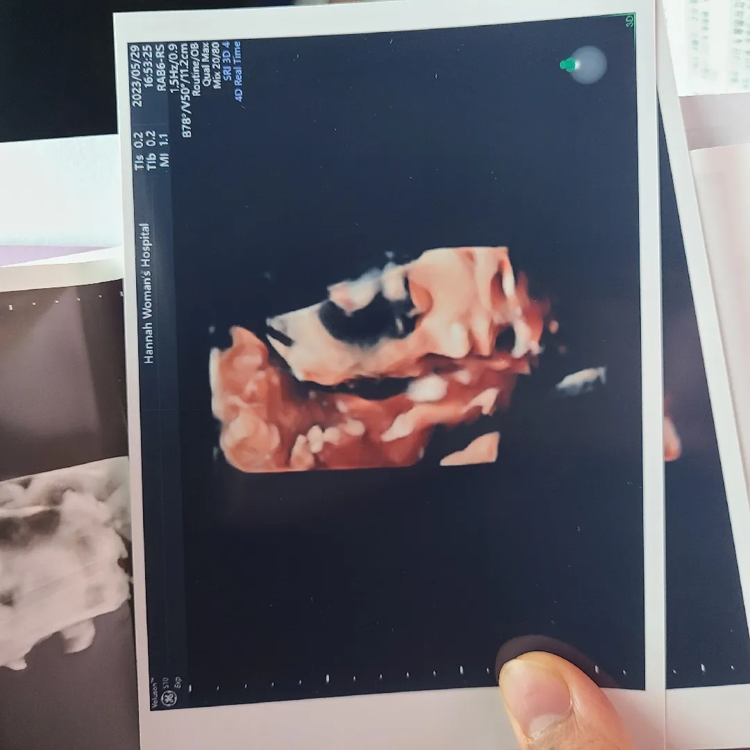 28주3일 입체초음파