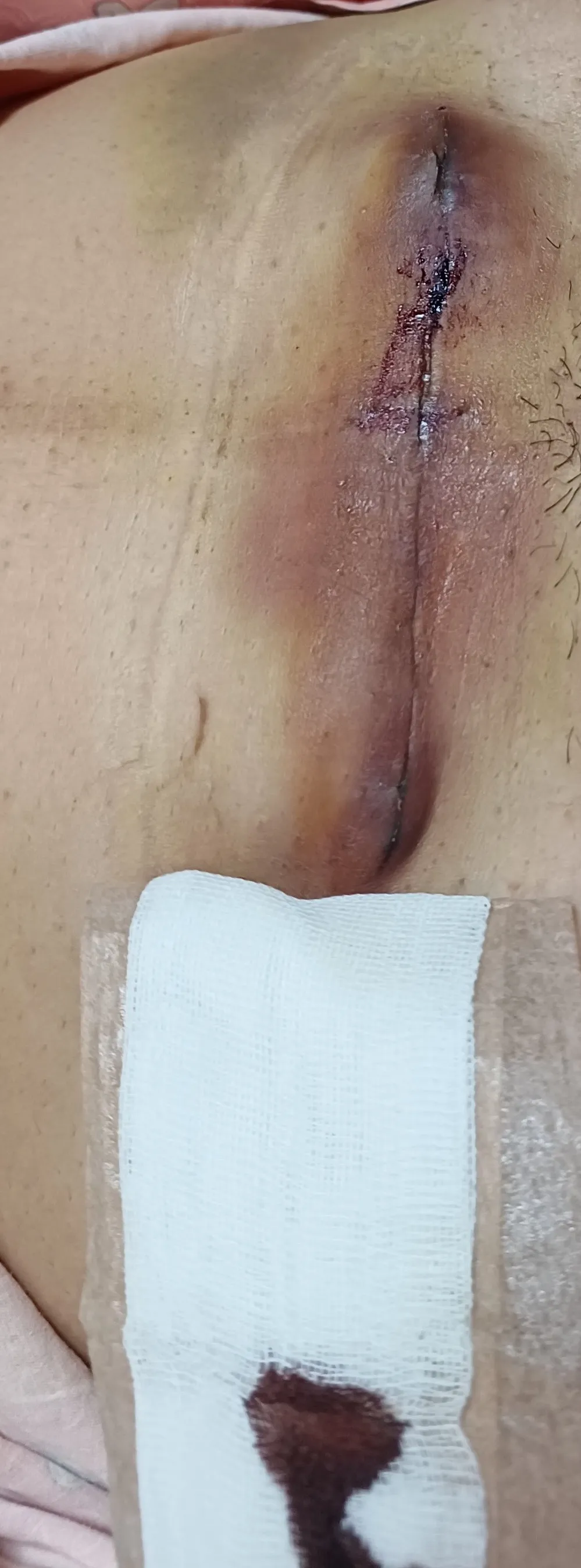 제왕절개ㅠㅠ(혐사진주의)
