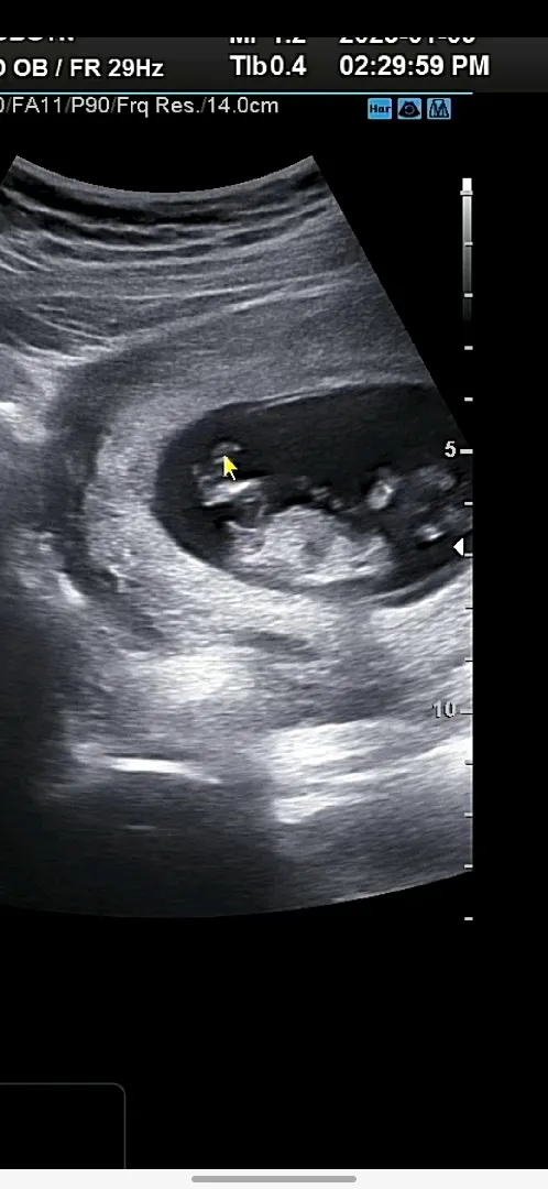12주 각도법 저부분이 확실히 탯줄은 아닌데 아들각도인가요?🧐
