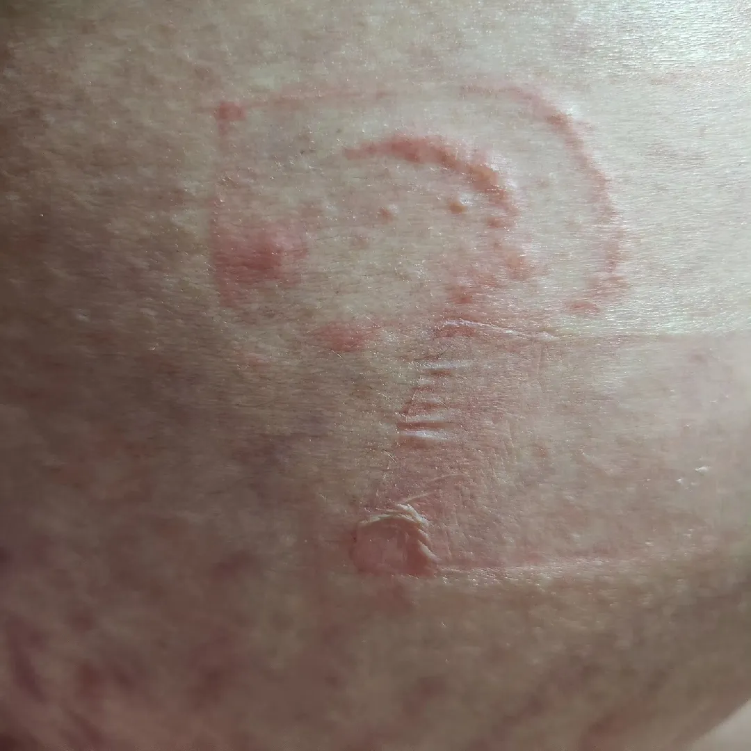 튼살때매 아파미치겠어요 1시간반 잤네요ㅠㅠ 자연분만포기....