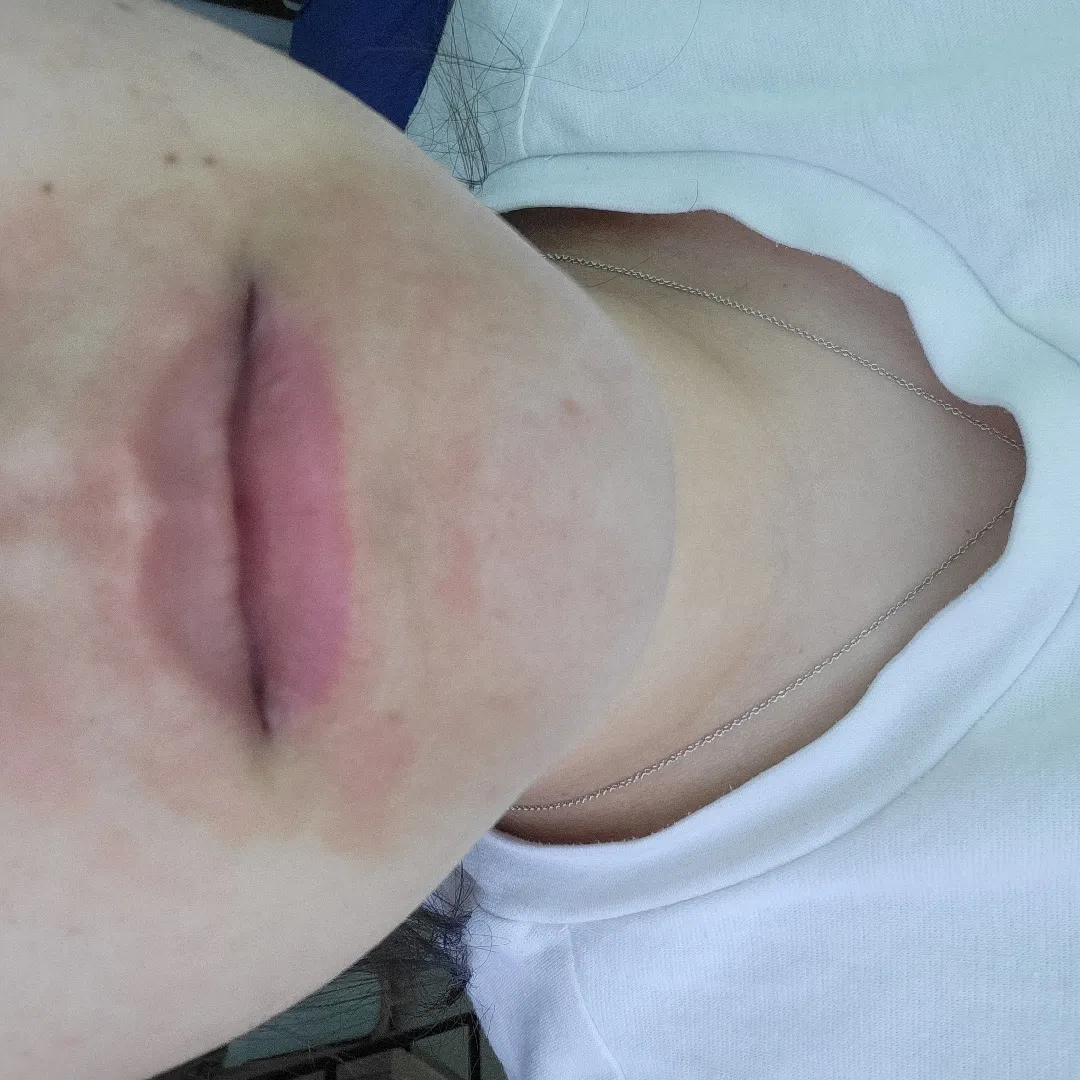 입술 주변 빨갛고 따가운 증상..