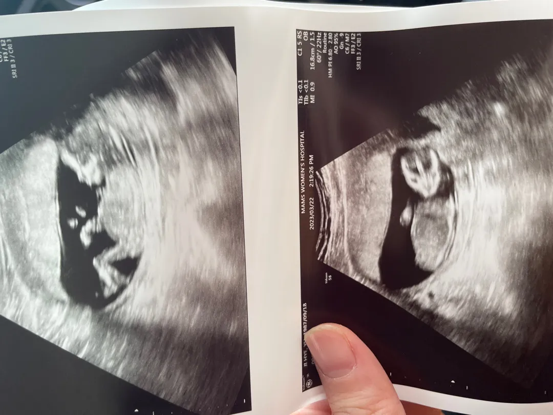 14주 딸확정요❤️❤️🌸👶🏻