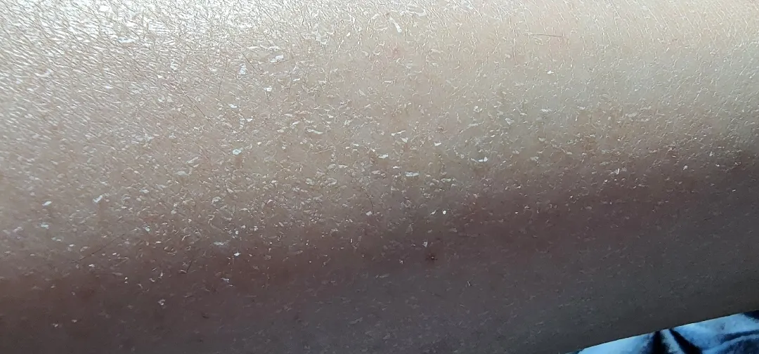갑자기 각질파티 하게되신분 계세요?(사진주의)