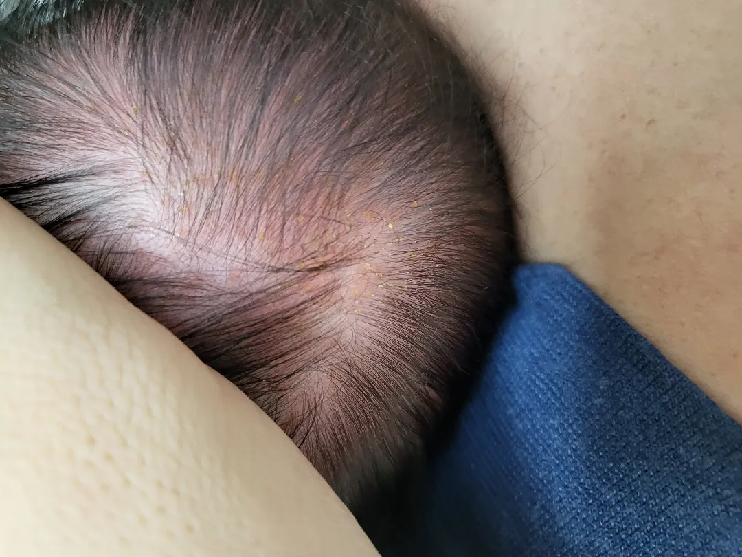 우리아가 지루성피부염인가요ㅠㅜ