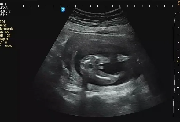 16주5일 2차검사일 성별