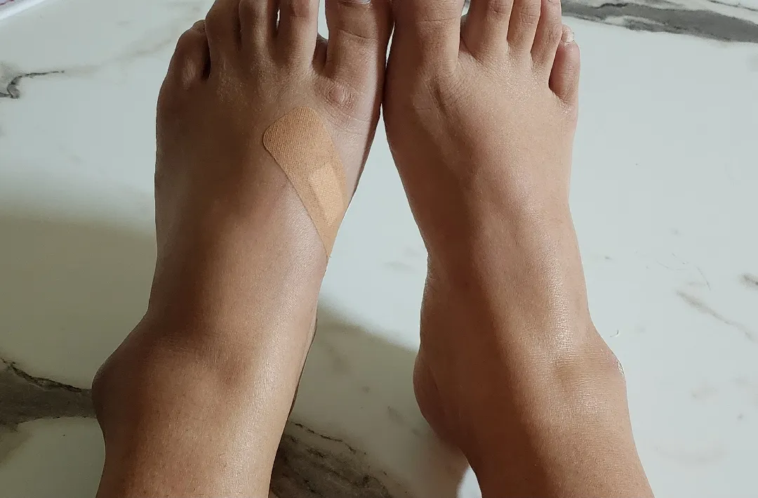 복숭아뼈 붓기