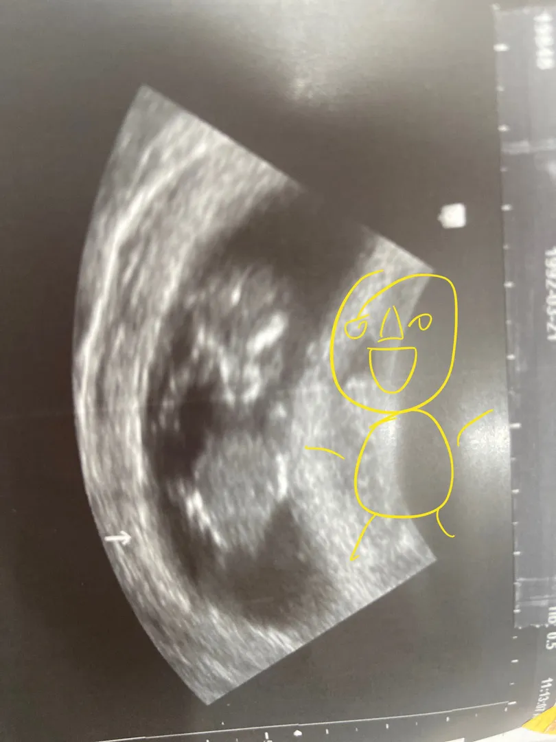 12주 아기 정면 초음파