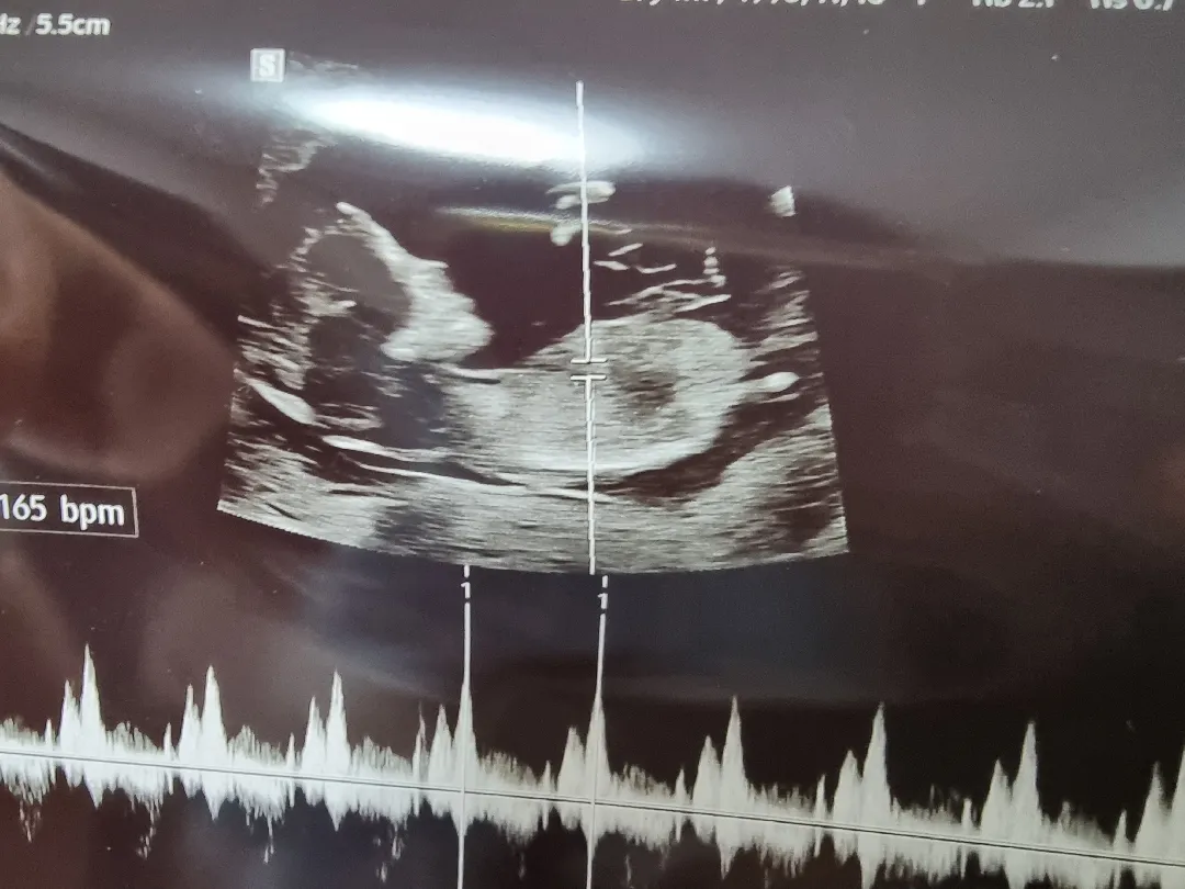 12주 5일 초음파 성별 한번 봐주세용!