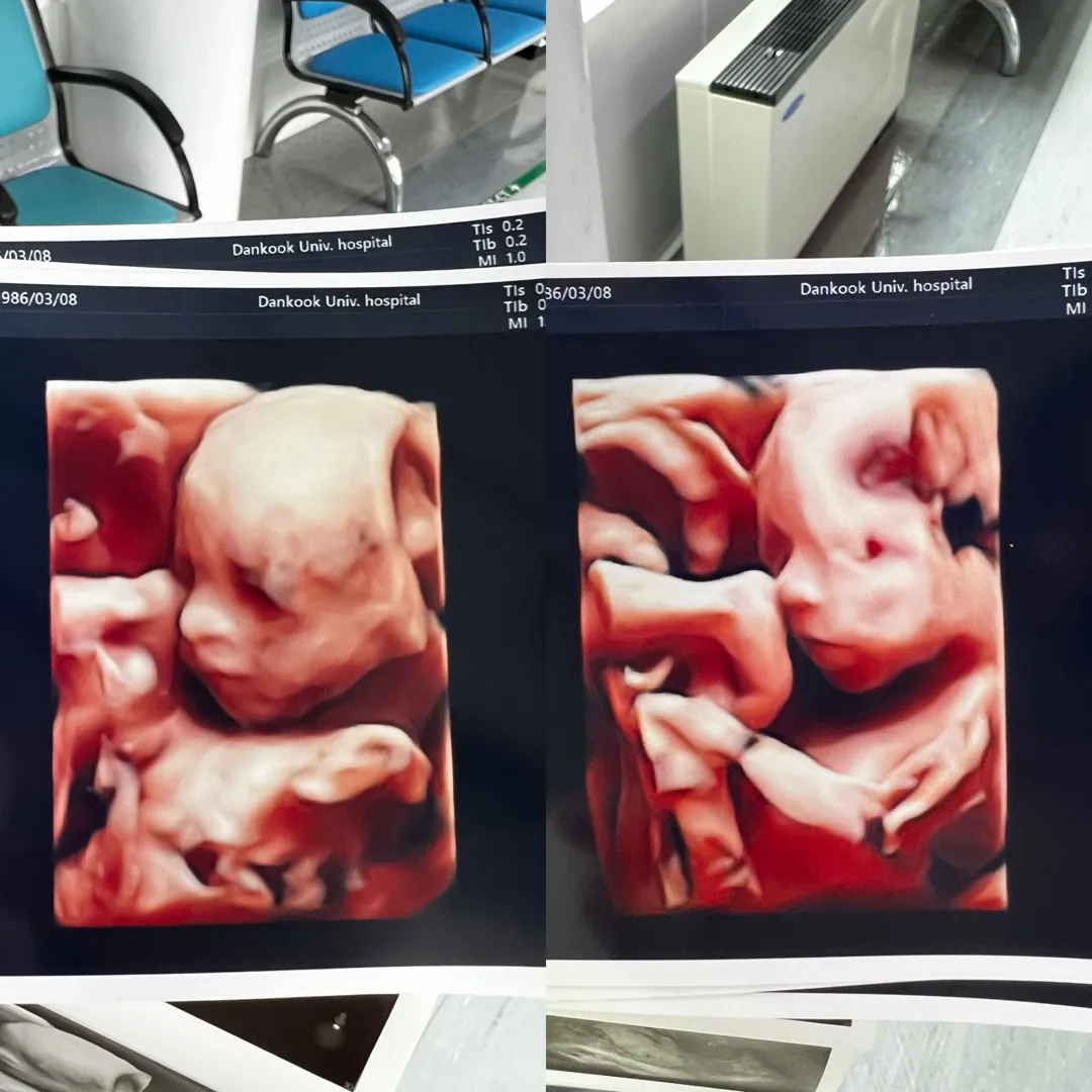 쌍둥이 정밀초음파보고왔어요:)