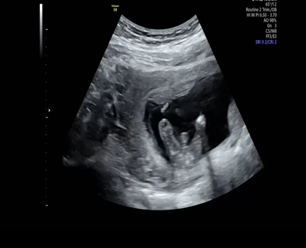 초음파보고왔는데 이건뭘까요?