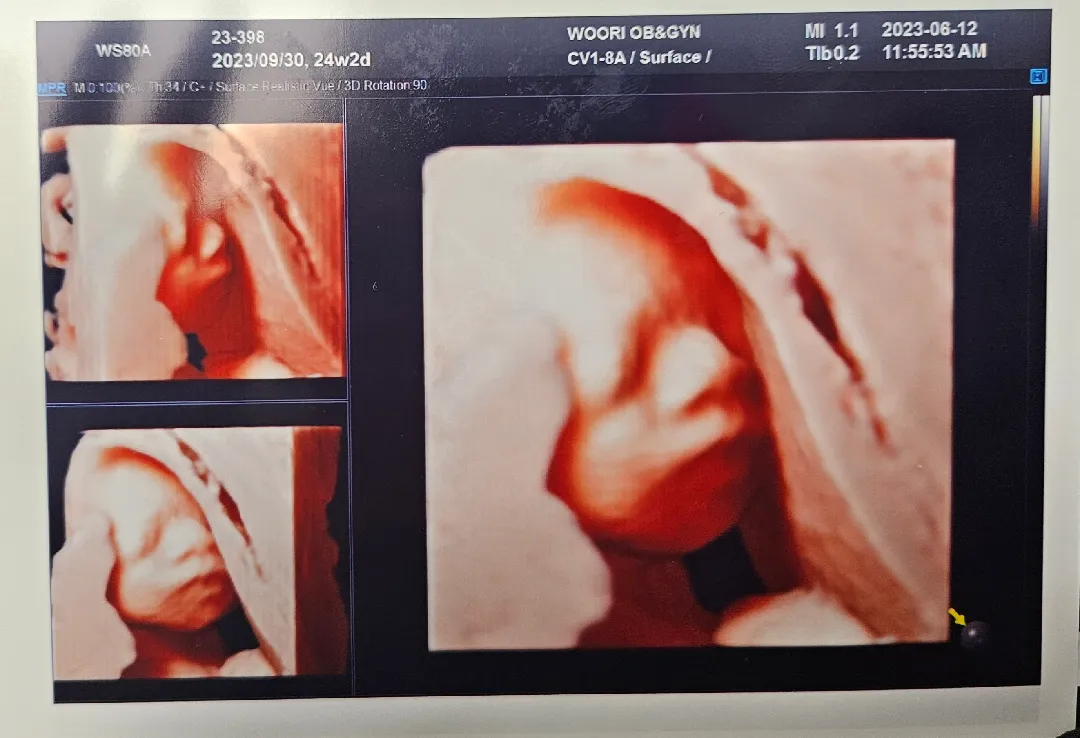 24주 2일 입초