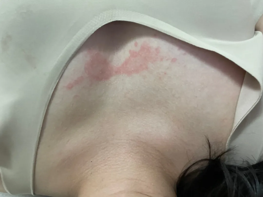 붉은 반점이 생기신분 계신가요? 
