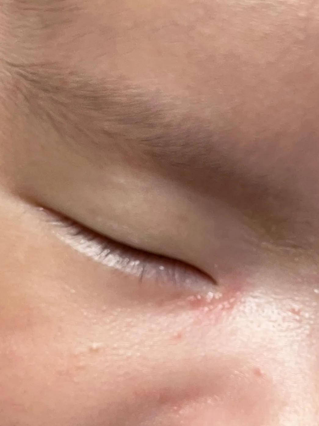 아기 눈 밑 태열?