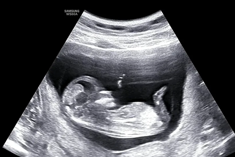 성별 확인가능하신분~(12주차 1일 사진)