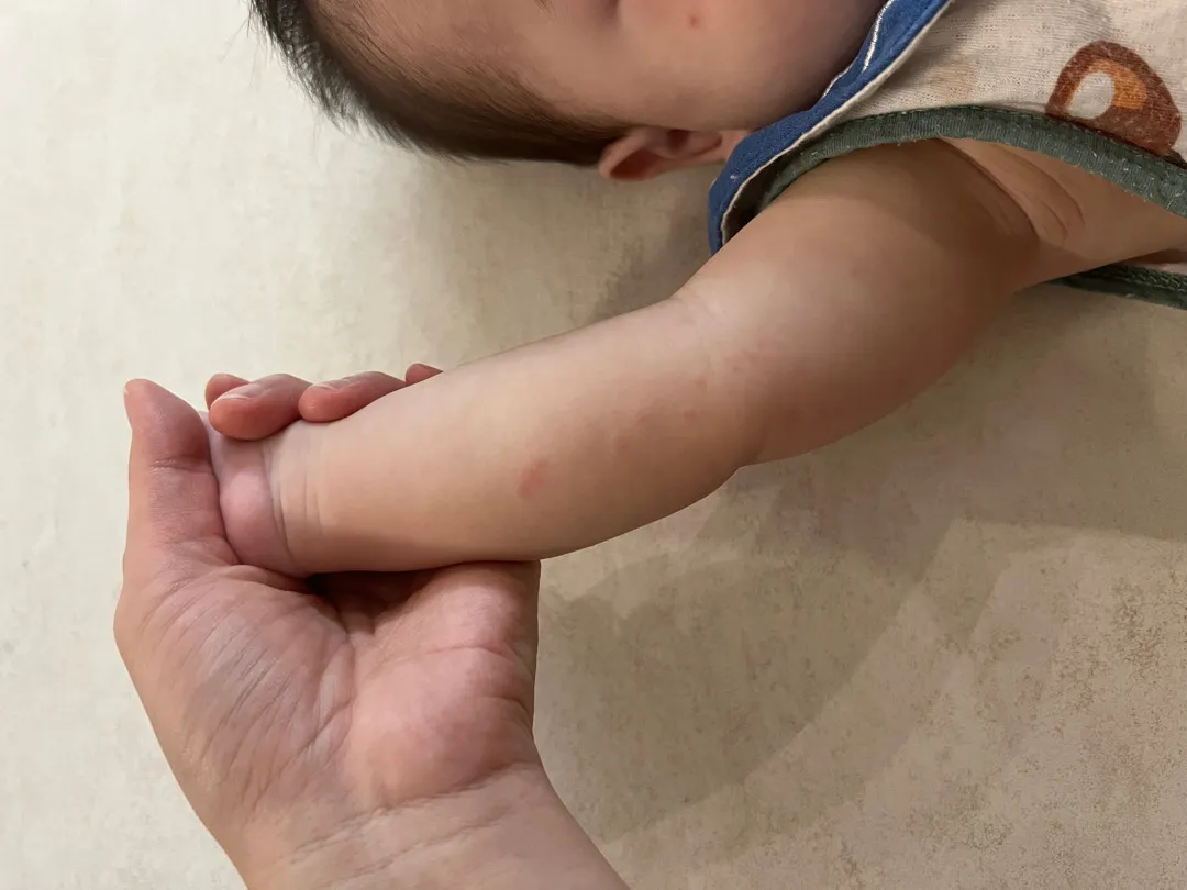 달걀노른자 알레르기