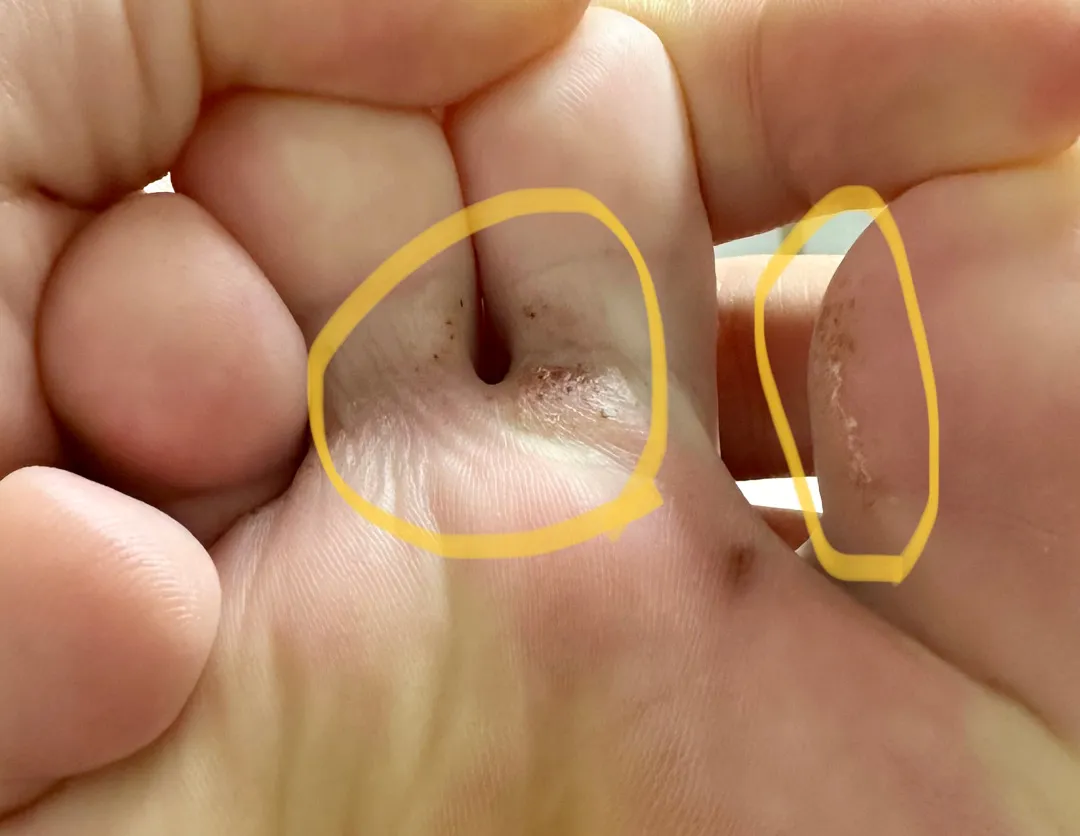 임신성 습진.. (발, 무좀의심..?) (발가락사진주의)