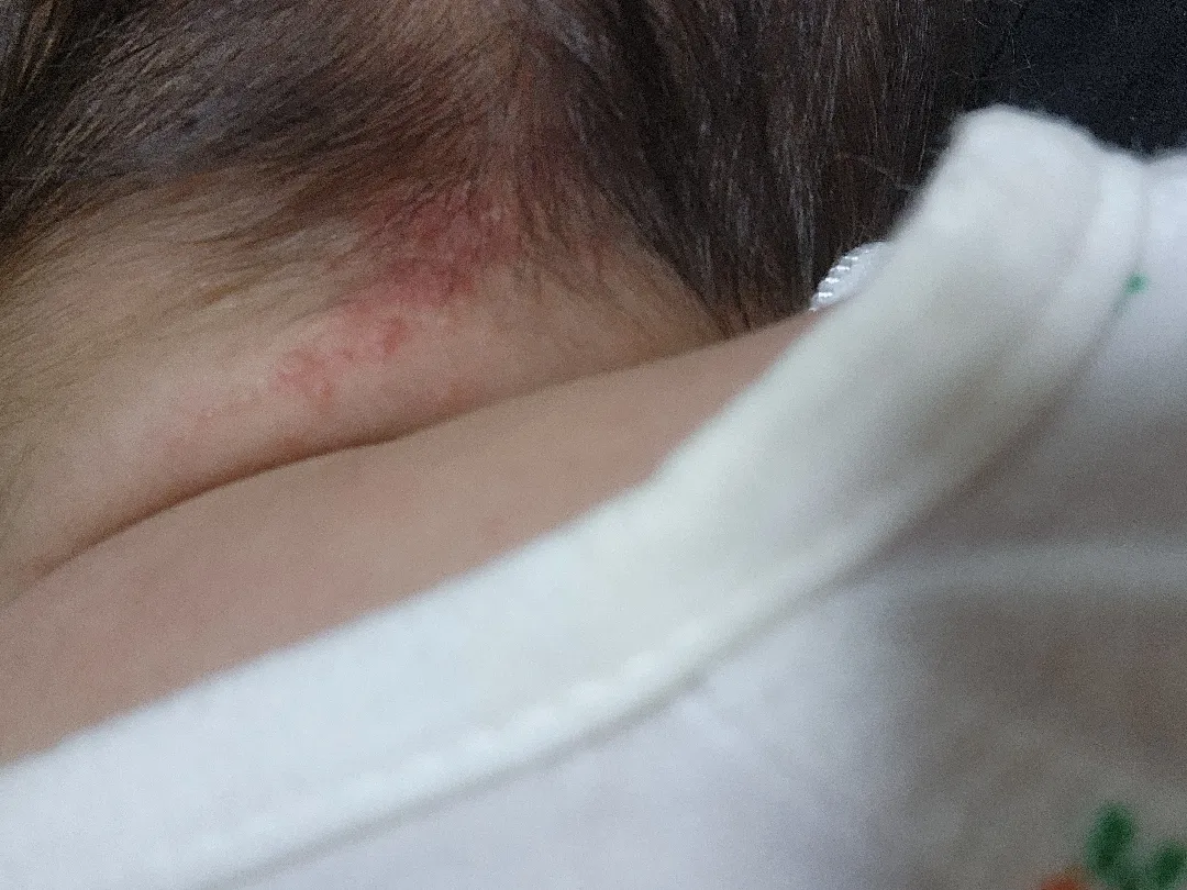 신생아 땀띠