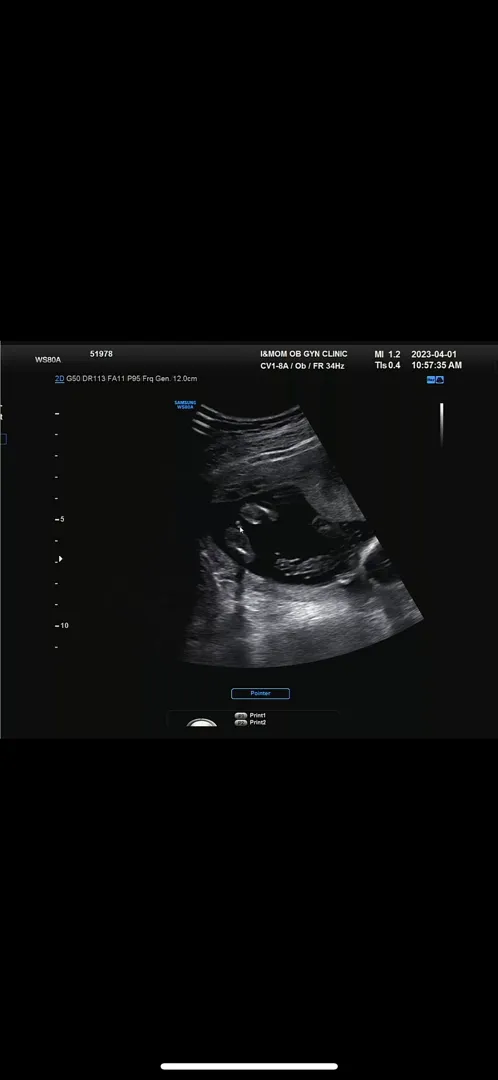 15주3일차 초음파사진 좀 봐주세요!!!