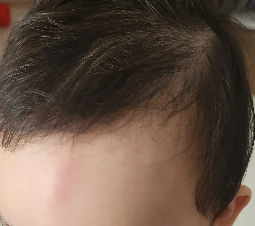 벽모서리에 쿵....