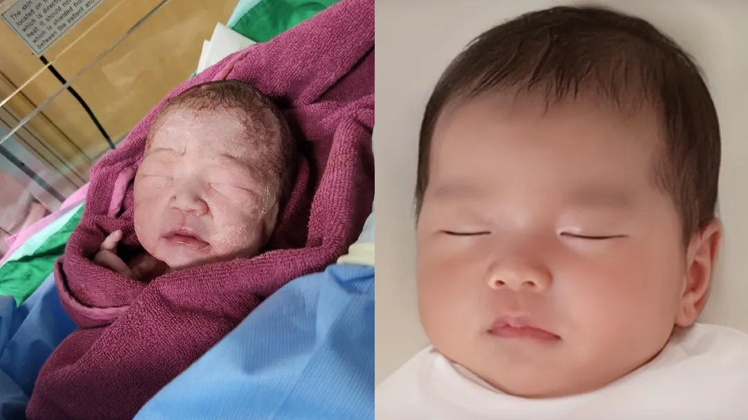 2.28 제왕절개로 출산했어요😖