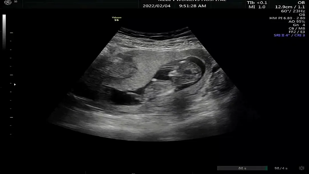 12주1일 기형아검사