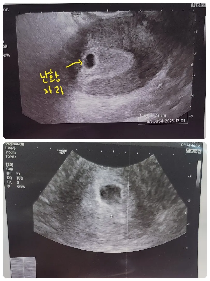 난황이 안보인대요ㅠㅠ걱정인형됬어요ㅠ
