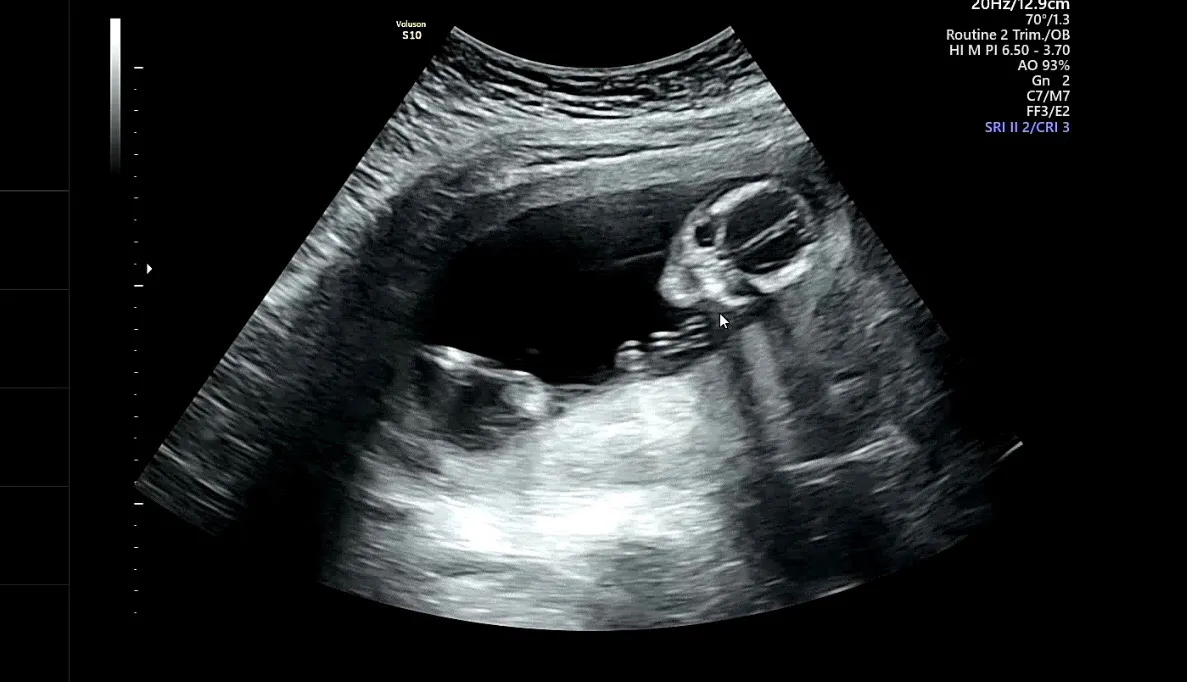 드디어 성별확인!!👶🏻🤍
