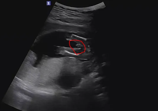 16주 2일 각도법 빼박 성별 남자아이? 