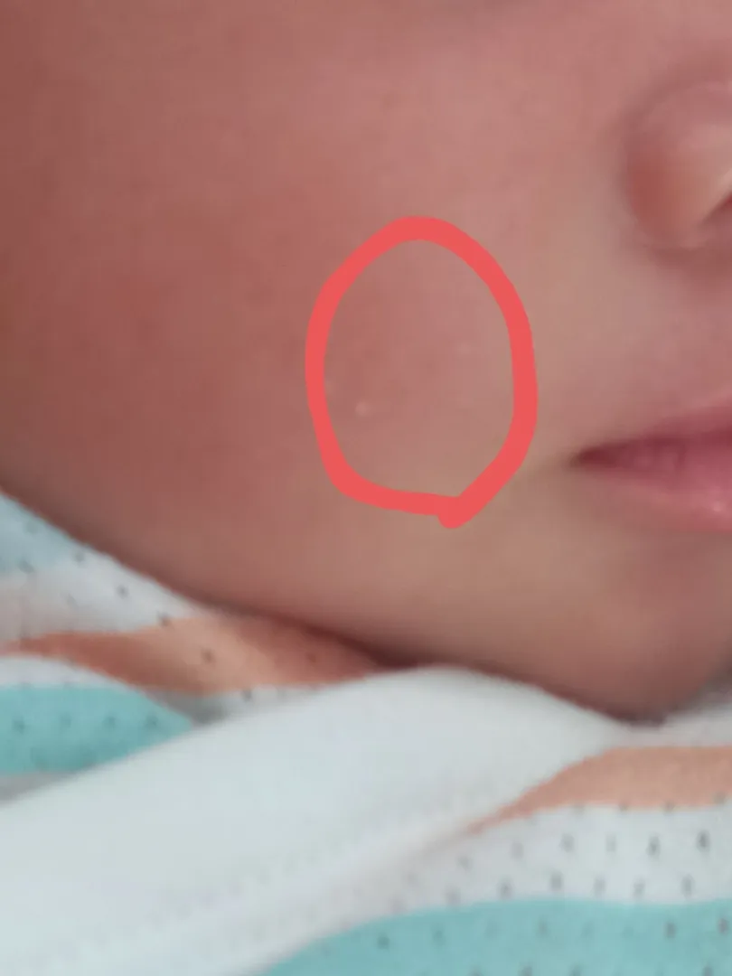 신생아 28일차 피부에난거 뭔가요?