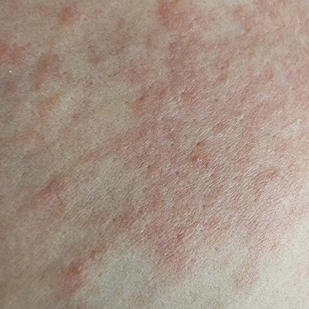 소양증 보습크림 추천 부탁드려요....