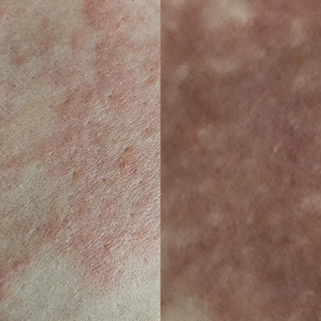 소양증..산부인과에서 약 처방받아왔어요