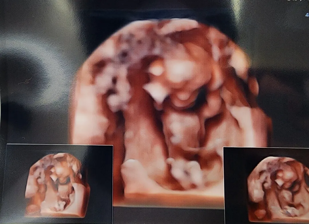 1차 기형아검사 하고왔어용~ 12주