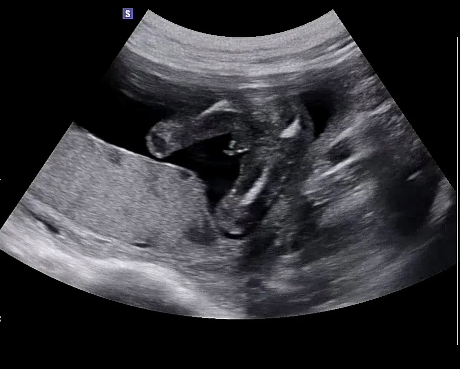 15주5일 성별반전이 저에게도!