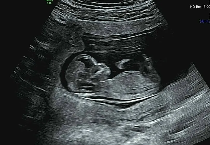 12주3일 기형아검사하고왔어용!