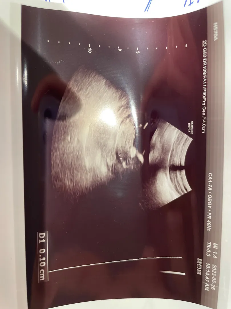 이게 기형아 NT값 잰거라는데 제대로 잰게 맞을까요 ㅠㅠ