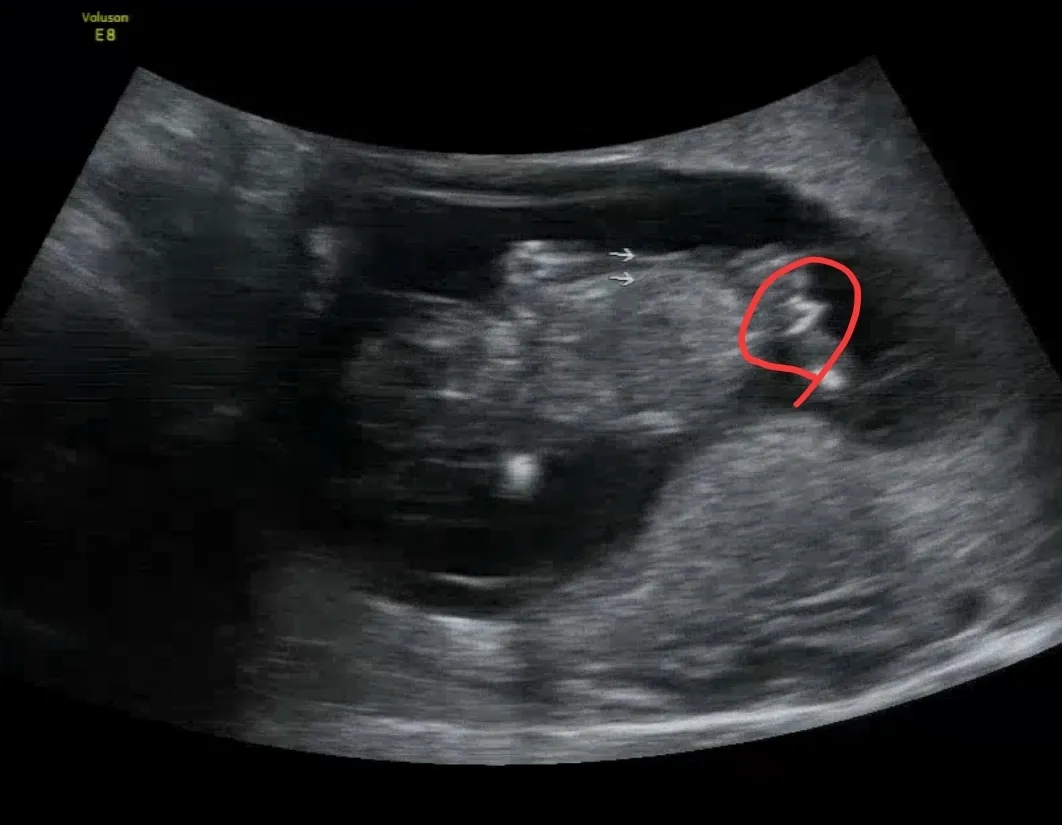 12주 1일 1차 기형아검사 하고 왔어요~