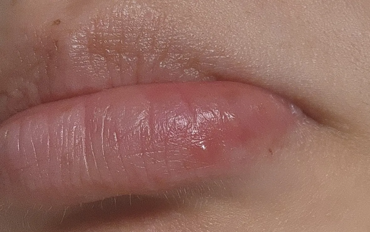 임산부가 쓰는 연고추천,,(사진주의)