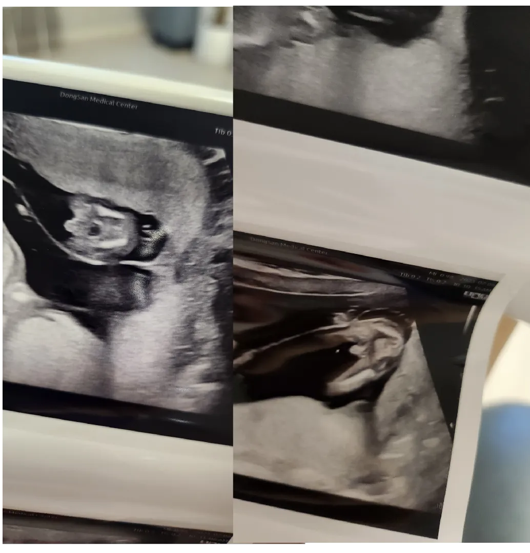 둥이 성별반전 기다립니당 15주