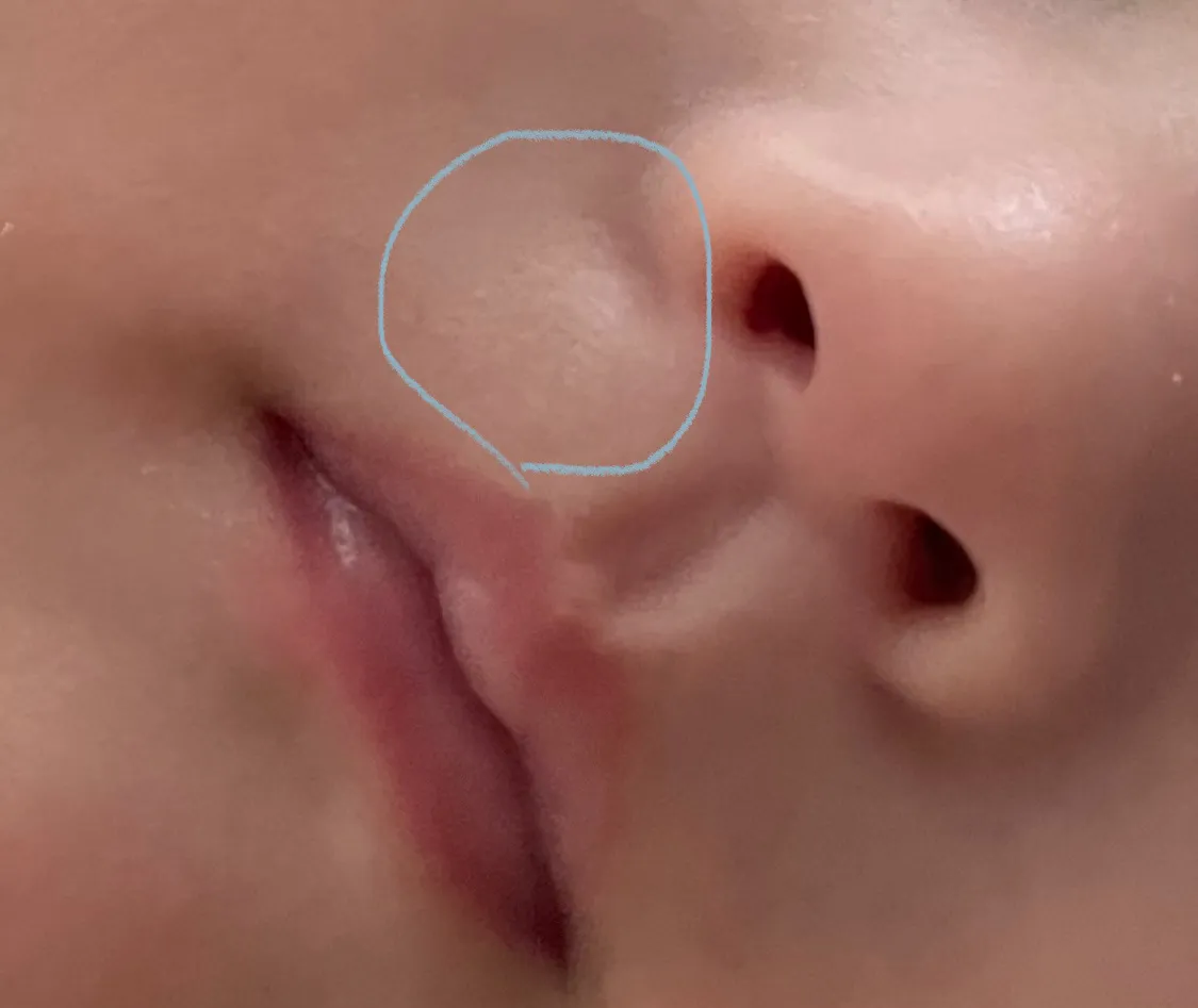 아가 코 밑에 흉터같은게 있어요
