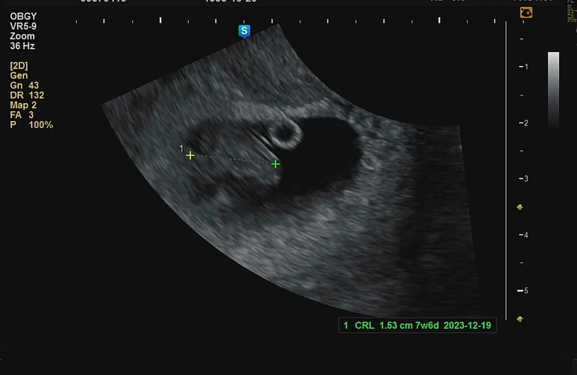7주6일차 초음파찍었는데.. 젤리곰은 아닌거같아요